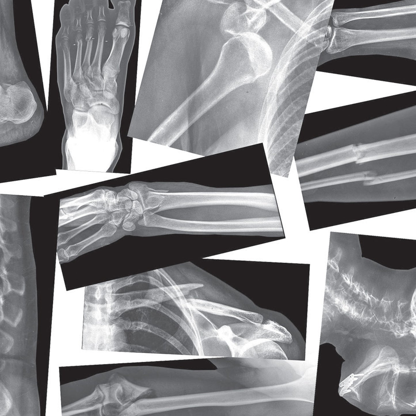 Broken Bones X-Ray Set, Pack of 15